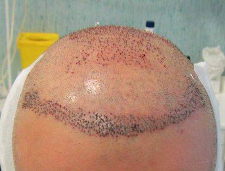 Trapianto Capelli FUE – 40 Anni – 2800 Innesti – 1 Sessione