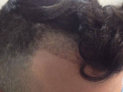 Trapianto Capelli FUE – 24 Anni – 1100 Innesti – 1 Sessione