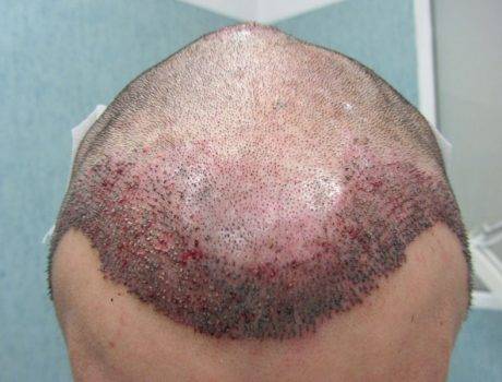 Trapianto Capelli FUE – 27 Anni – 2000 Innesti – 1 Sessione