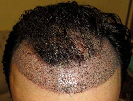 Trapianto Capelli FUE – 27 Anni – 4200 Innesti – 2 Sessioni