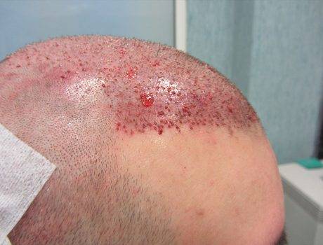 Trapianto Capelli FUE – 25 Anni – 2050 Innesti – 1 Sessione