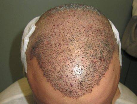 Trapianto Capelli FUE – 24 Anni – 3460 Innesti – 2 Sessioni