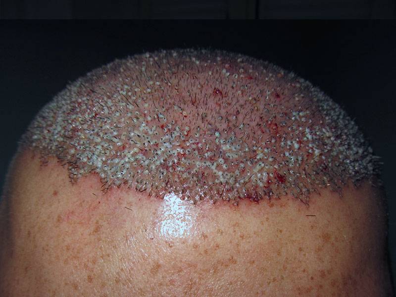 Trapianto Capelli FUE – 38 Anni – 2500 Innesti – 1 Sessione