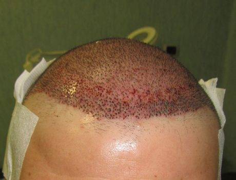 Trapianto Capelli FUE – 43 Anni – 5700 Innesti – 2 Sessioni