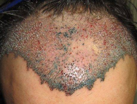 Trapianto Capelli FUE – 38 Anni – 2230 Innesti – 1 Sessione