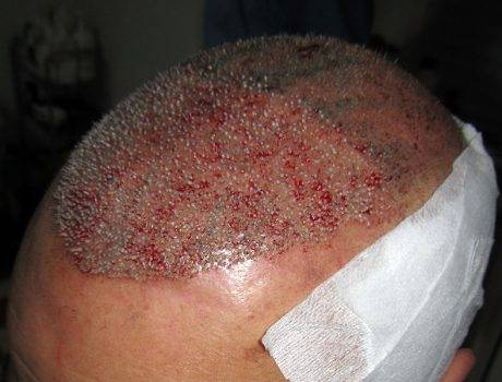 Trapianto Capelli FUE – 60 Anni – 3800 Innesti – 2 Sessioni
