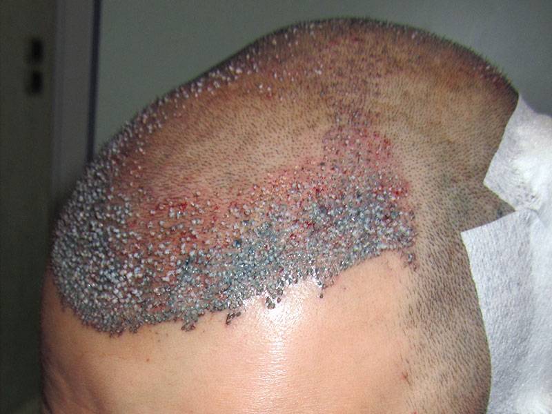 Trapianto Capelli FUE – 29 Anni – 2800 Innesti – 1 Sessione