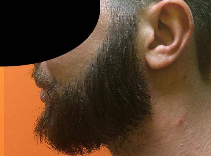 Trapianto di Barba: Cos’è, Procedura, Foto e Costi nel 2025