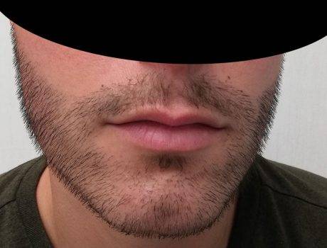 Trapianto Barba – 30 Anni – 4000 Innesti – 2 Sessioni