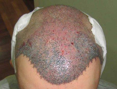 Trapianto Capelli FUE – 34 Anni – 3000 Innesti – 1 Sessione