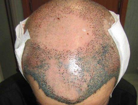 Trapianto Capelli FUE – 41 Anni – 4100 Innesti – 2 Sessioni