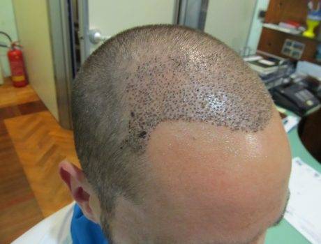 Trapianto Capelli FUE – 32 Anni – 1500 Innesti – 1 Sessione