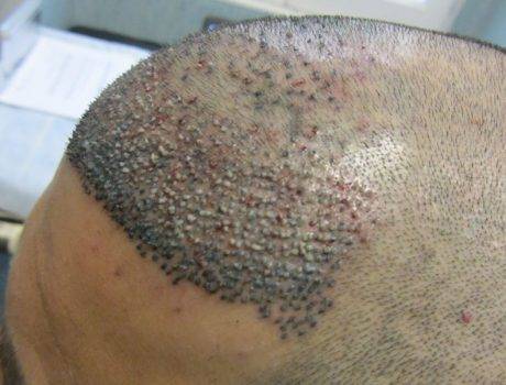 Trapianto Capelli FUE – 37 Anni – 1200 Innesti – 1 Sessione