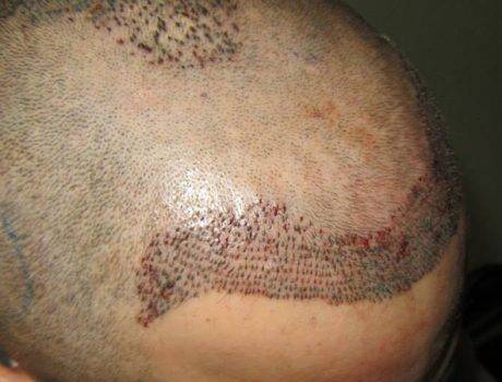 Trapianto Capelli FUE – 40 Anni – 2200 Innesti – 1 Sessione