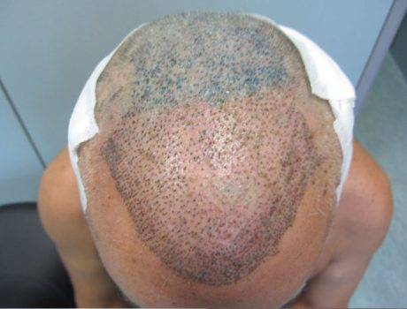 Trapianto Capelli FUE – 59 Anni – 2000 Innesti – 1 Sessione