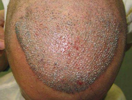 Trapianto Capelli FUE – 31 Anni – 2100 Innesti – 1 Sessione