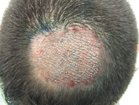 Trapianto Capelli FUE – 39 Anni – 1200 Innesti – 1 Sessione