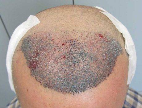 Trapianto Capelli FUE – 43 Anni – 3500 Innesti – 2 Sessioni