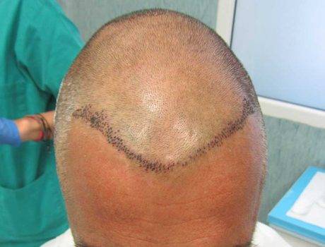 Trapianto Capelli FUE – 54 Anni – 2300 Innesti – 1 Sessione