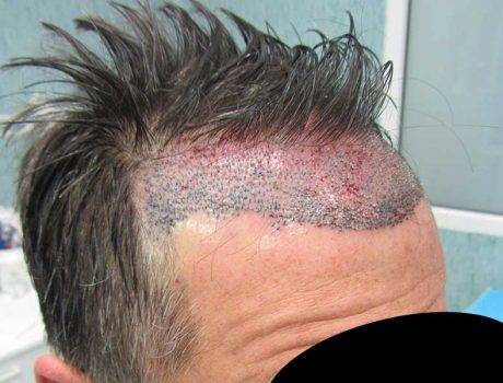 Trapianto Capelli FUE – 52 Anni – 1500 Innesti – 1 Sessione