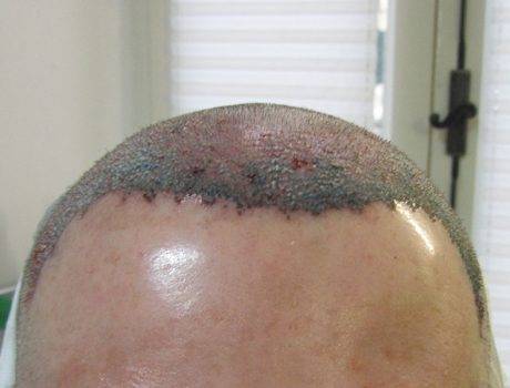 Trapianto Capelli FUE – 36 Anni – 2000 Innesti – 1 Sessione