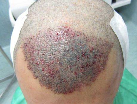 Trapianto Capelli FUE – 50 Anni – 2000 Innesti – 1 Sessione