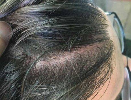 Trapianto Capelli FUE – 27 Anni – 3650 Innesti – 2 Sessioni