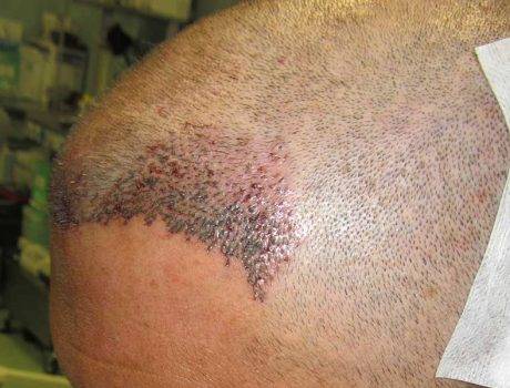 Trapianto Capelli FUE – 42 Anni – 2100 Innesti – 1 Sessione