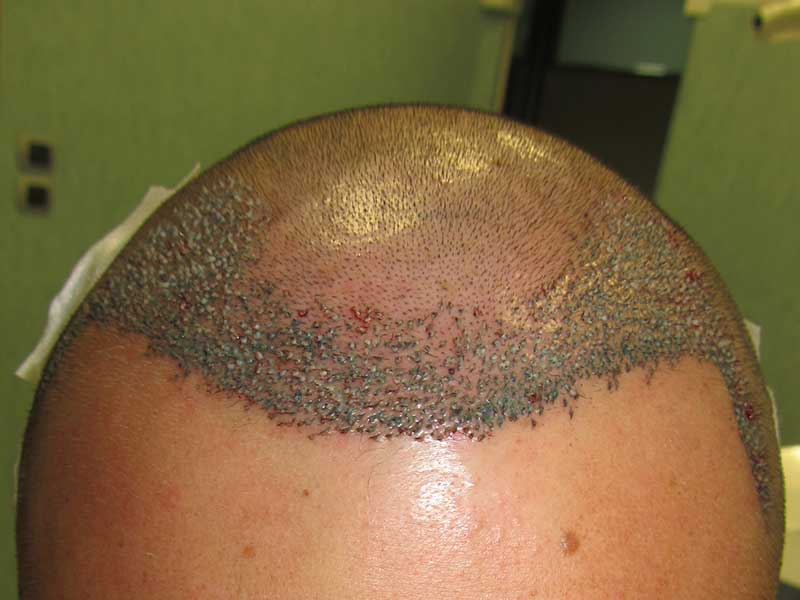 Trapianto Capelli FUE – 28 Anni – 1750 Innesti – 1 Sessione