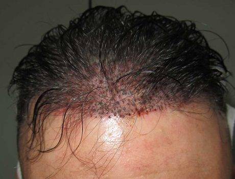 Trapianto Capelli FUE – 37 Anni – 2000 Innesti – 1 Sessione