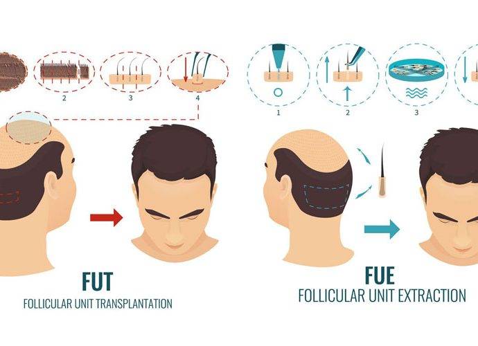 Trapianto capelli con tecnica FUE: quali differenze con la FUT?