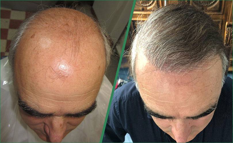 innesto capelli naturali