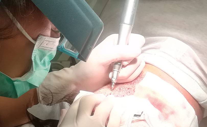 Autotrapianto Capelli con tecnica FUE: l’intervento fase dopo fase