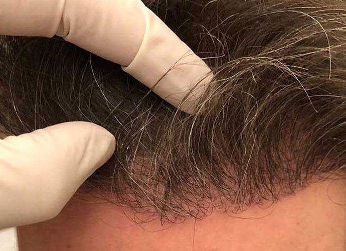 Il metodo CNC combinato a un Trapianto di Capelli FUE