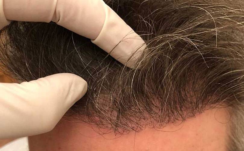 Il metodo CNC combinato a un Trapianto di Capelli FUE