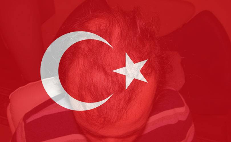 Trapianto Capelli Turchia … altro che vacanza