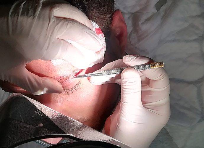 Trapianto di Sopracciglia: Come Funziona, Costi, Risultati e Rischi