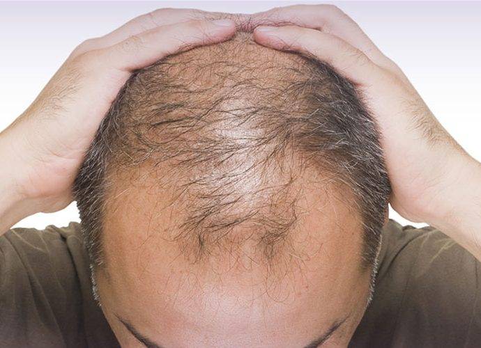Quanti tipi di calvizie e alopecia esistono? E le cure?