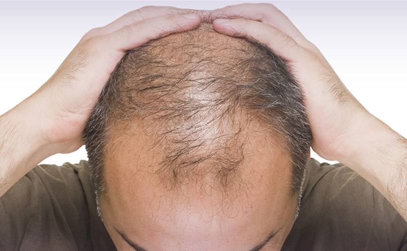 Quanti tipi di calvizie e alopecia esistono? E le cure?