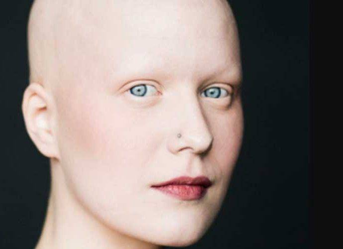 Alopecia Universale: cos’è, cause e cure