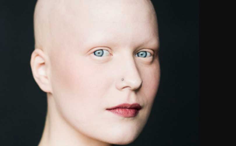 Alopecia Universale: cos’è, cause e cure