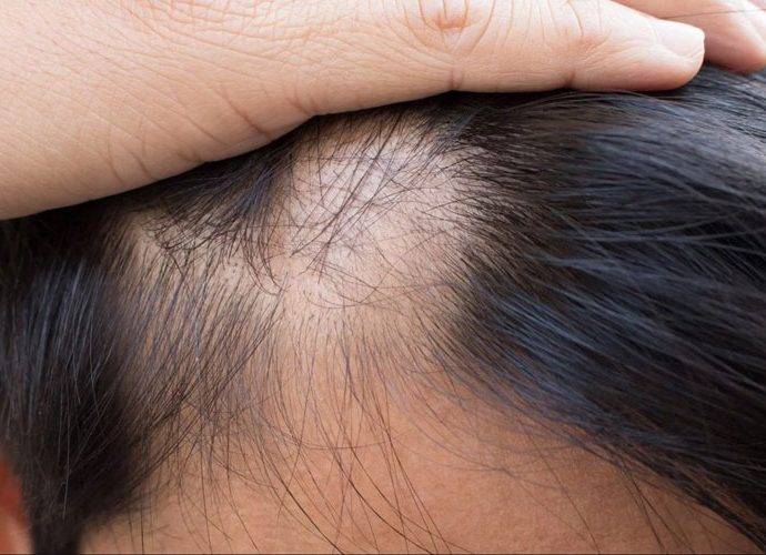 Alopecia Areata: cos’è, cause e cure