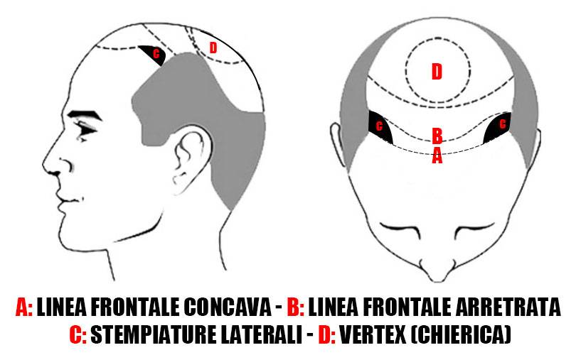 Arretramento Linea Frontale Capelli