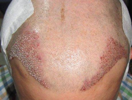 Trapianto Capelli FUE – 29 Anni, 2240 Innesti, 1 Sessione