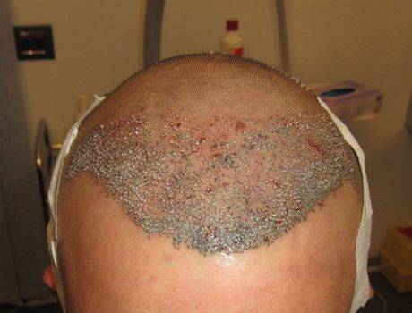 Trapianto Capelli FUE – 30 Anni – 2750 Innesti – 1 Sessione