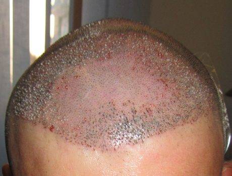 Trapianto Capelli FUE – 38 Anni – 4000 Innesti – 2 Sessioni