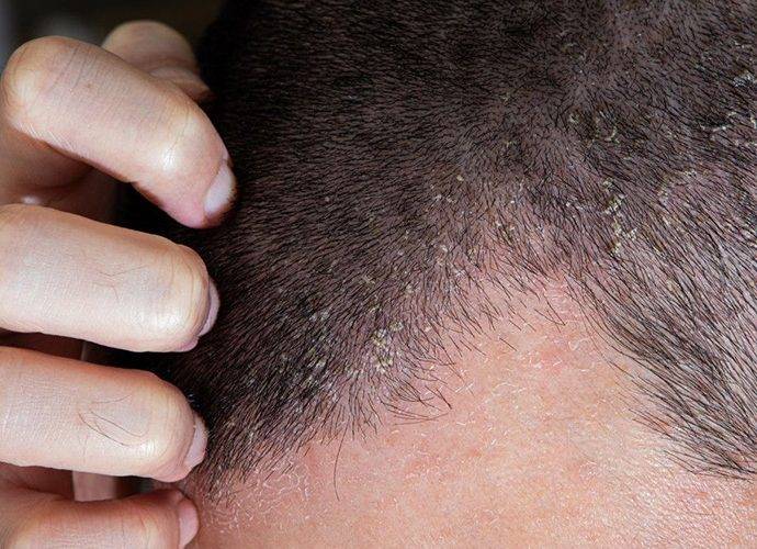 Alopecia Seborroica: cos’è, cause, diagnosi e come combatterla