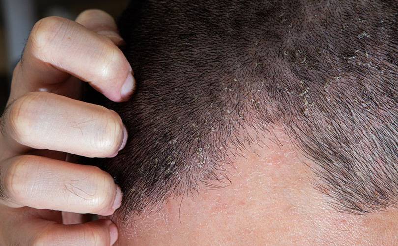 Alopecia Seborroica: cos’è, cause, diagnosi e come combatterla