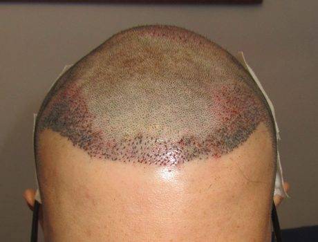 Trapianto Capelli FUE – 32 Anni – 2700 Innesti – 1 Sessione