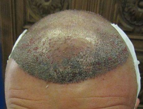 Trapianto Capelli FUE – 48 anni – 3500 Innesti – 1 Sessione